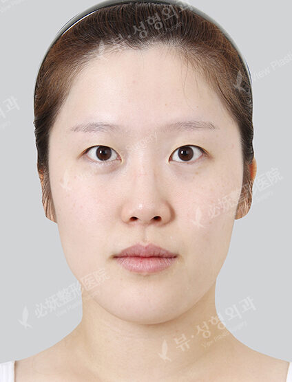 Nano Two Jaw+Doll Line+Zygoma Reduction+Forehead Implant+Rhinoplasty+Fat Graft (7 Months ) — Before