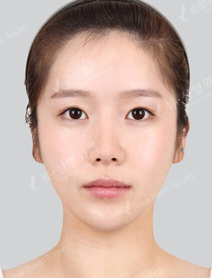 Nano Two Jaw+Doll Line+Zygoma Reduction+Forehead Implant+Rhinoplasty+Fat Graft (7 Months ) — After
