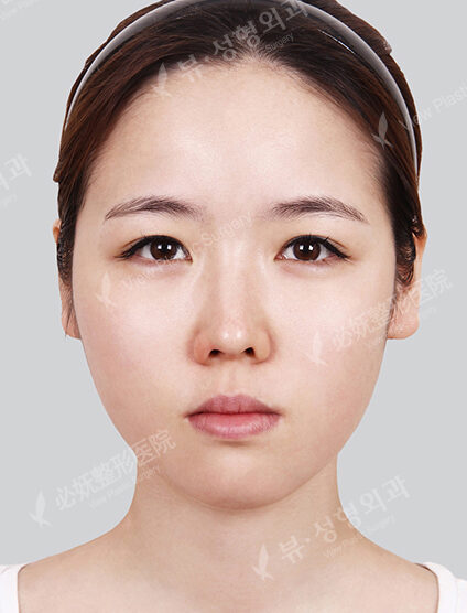 Nano Two Jaw+Doll Line (Vline)+ Zygoma Reduction)(10 Months) — Before