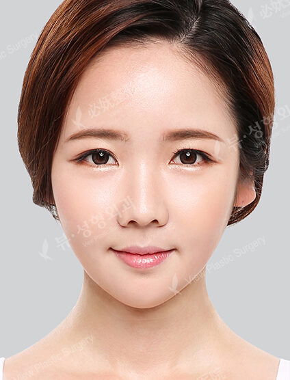 Nano Two Jaw+Doll Line (Vline)+ Zygoma Reduction)(10 Months) — After