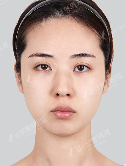 Nano Two Jaw+Natural Vline+Zygoma Reduction+Combination Ptosis Correction Surgery+Forehead Implant+Rhinoplasty (6 Months) — Before
