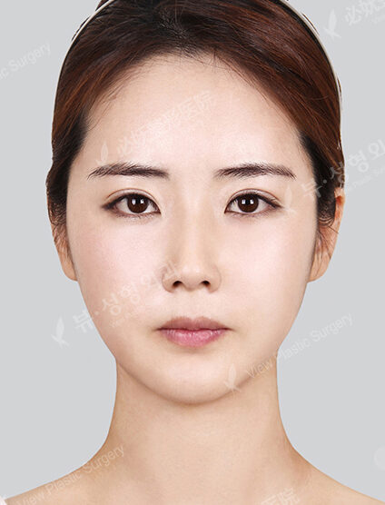 Nano Two Jaw+Natural Vline+Zygoma Reduction+Combination Ptosis Correction Surgery+Forehead Implant+Rhinoplasty (6 Months) — After