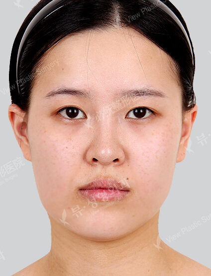 Nano Two Jaw+Natural Vline+Zygoma Reduction+Frontal Cheek Implant+Revisional Eye Surgery+Lower Canthoplasty(6 Months) — Before