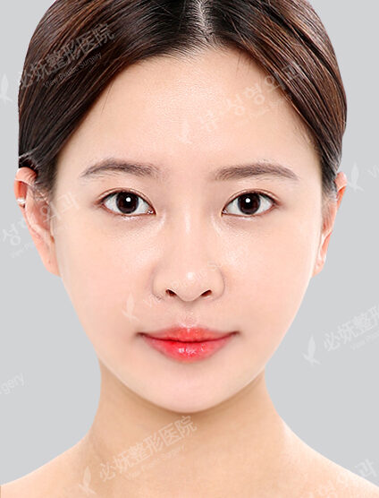 Nano Two Jaw+Natural Vline+Zygoma Reduction+Frontal Cheek Implant+Revisional Eye Surgery+Lower Canthoplasty(6 Months) — After