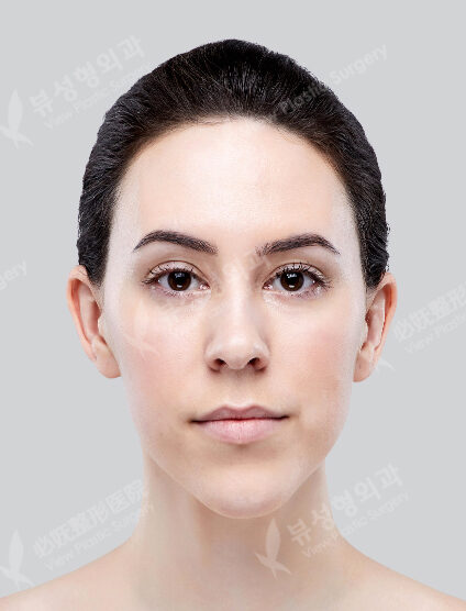 Two Jaw+Zygoma Reduction+Genioplasty (6 Months) — Before
