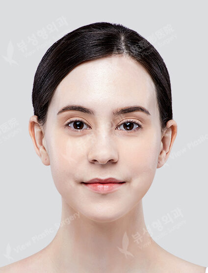 Two Jaw+Zygoma Reduction+Genioplasty (6 Months) — After