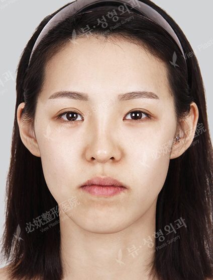 Nano Two Jaw+Doll Line (Angular Jaw+Front Chin)+ Cheekbone+Forehead (Implant)+ Rhinoplasty+Ptosis (Epicanthoplasty+Lateral Canthoplasty+Lower Canthoplasty)_6 Months — Before