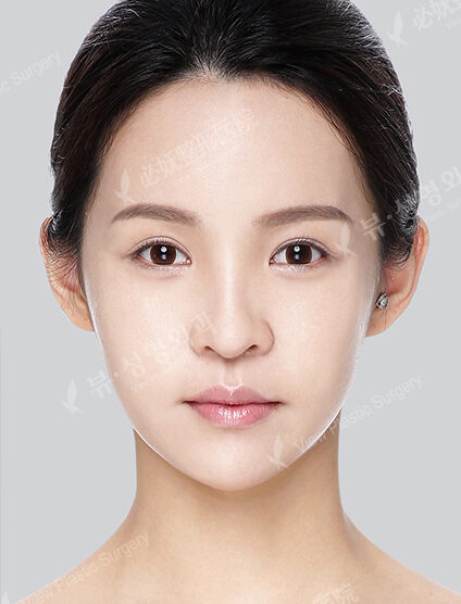Nano Two Jaw+Doll Line (Angular Jaw+Front Chin)+ Cheekbone+Forehead (Implant)+ Rhinoplasty+Ptosis (Epicanthoplasty+Lateral Canthoplasty+Lower Canthoplasty)_6 Months — After