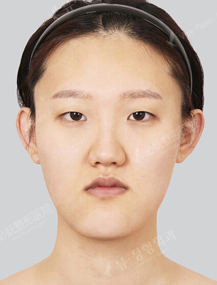 Nano Two Jaw+Natural Vline+Transparent Braces+Ptosis+Epicanthoplasty+Fat Graft (4 Months) — Before