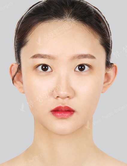 Nano Two Jaw+Natural Vline+Transparent Braces+Ptosis+Epicanthoplasty+Fat Graft (4 Months) — After