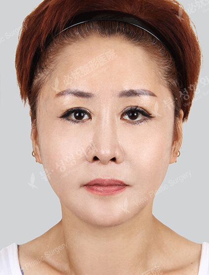 Natural Vline+Zygoma Reduction+PA+Smart Lifting (3 Months) — After