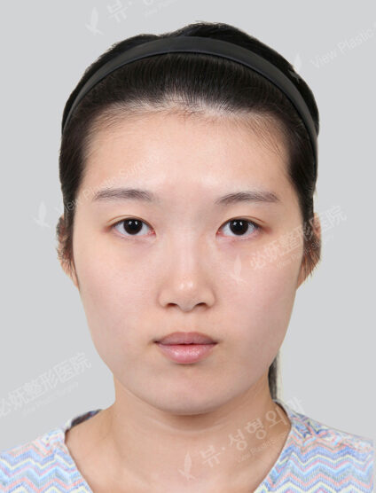 3 Types Face Contouring (Cheekbone+Angular Jaw+Chin Tip)(12 Months) — Before