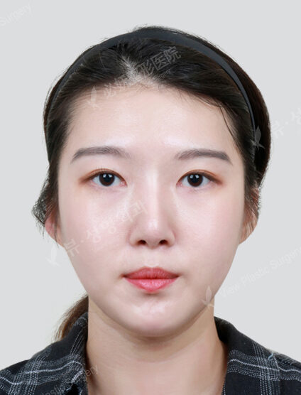3 Types Face Contouring (Cheekbone+Angular Jaw+Chin Tip)(12 Months) — After