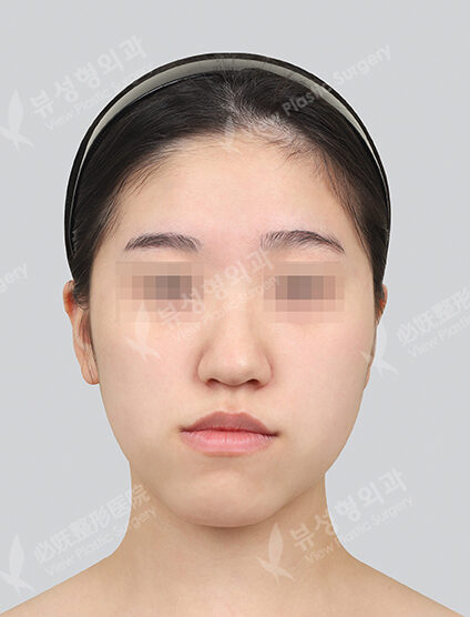 Two Jaw Surgery+Front ChinT Osteotomy (6 Months) — Before