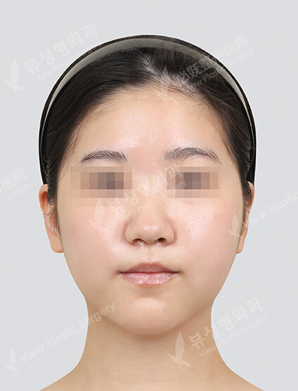 Two Jaw Surgery+Front ChinT Osteotomy (6 Months) — After
