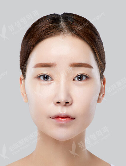 Angular Jaw+ Cheekbone(10 Months) — Before