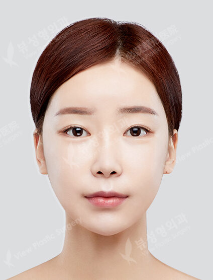Angular Jaw+ Cheekbone(10 Months) — After