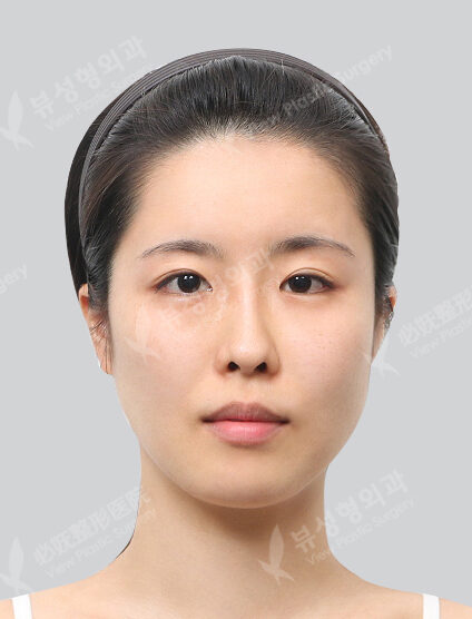 Two Jaw Surgery (Combination Ptosis Correction)+ Zygoma Reduction+Epicanthoplasty (6 Months) — Before