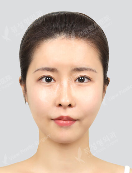 Two Jaw Surgery (Combination Ptosis Correction)+ Zygoma Reduction+Epicanthoplasty (6 Months) — After