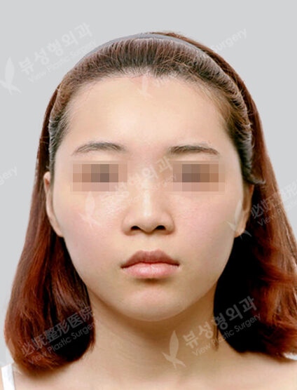 Zygoma Reduction+Revisional Rhinoplasty (Hump Nose )(6 Months) — Before