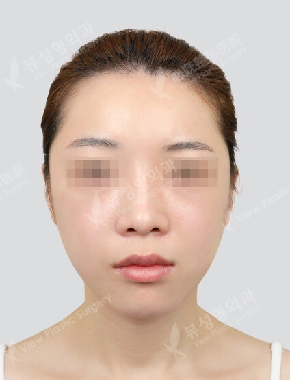 Zygoma Reduction+Revisional Rhinoplasty (Hump Nose )(6 Months) — After