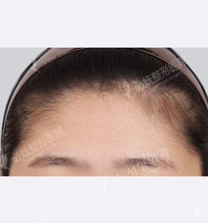 Forehead Implant (6 Months) — Before