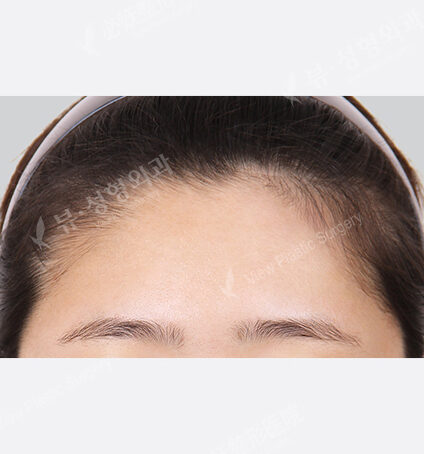 Forehead Implant (6 Months) — After