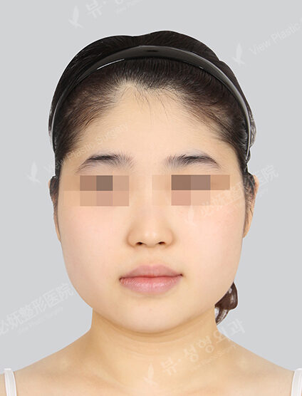 Natural Vline+Zygoma Reduction+Combination Ptosis Correction Surgery+Epicanthoplasty+Lateral Canthoplasty+Lower Canthoplasty+Nose(23 Week) — Before