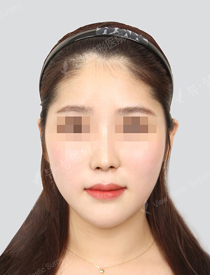 Natural Vline+Zygoma Reduction+Combination Ptosis Correction Surgery+Epicanthoplasty+Lateral Canthoplasty+Lower Canthoplasty+Nose(23 Week) — After