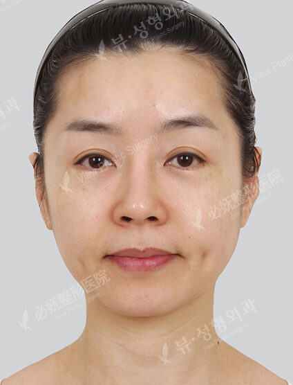 Natural Vline + Cheekbone Implant(2 Months) — Before