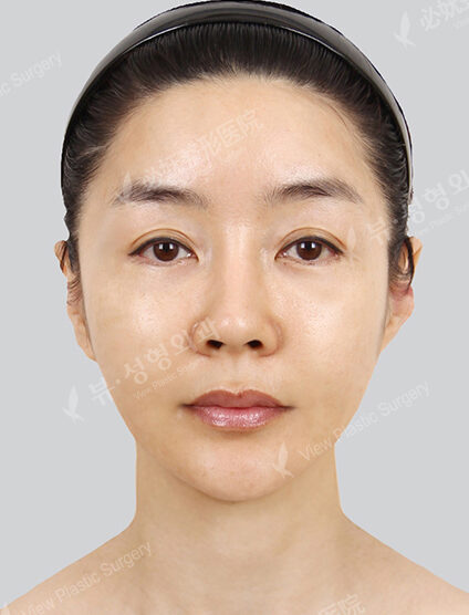 Natural Vline + Cheekbone Implant(2 Months) — After
