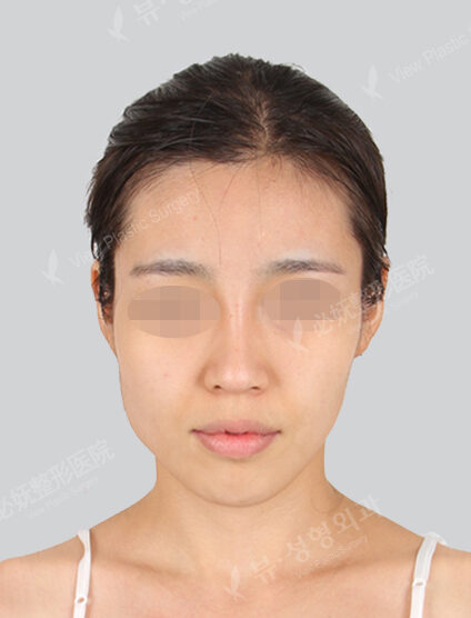 Doll Line (Vline)+ Zygoma Reduction (3 Months) — Before