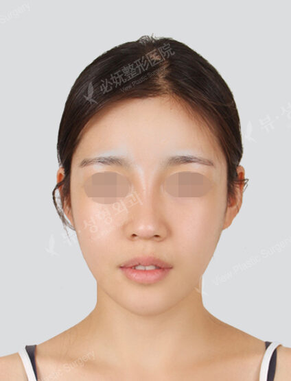 Doll Line (Vline)+ Zygoma Reduction (3 Months) — After