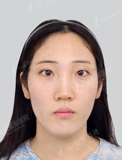 Doll Line (Vline)+ Fat Graft+Lateral Canthoplasty+Lower Canthoplasty+Hump Nose +Fat Graft (3 Months) — Before