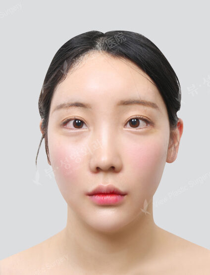 Doll Line (Vline)+ Fat Graft+Lateral Canthoplasty+Lower Canthoplasty+Hump Nose +Fat Graft (3 Months) — After