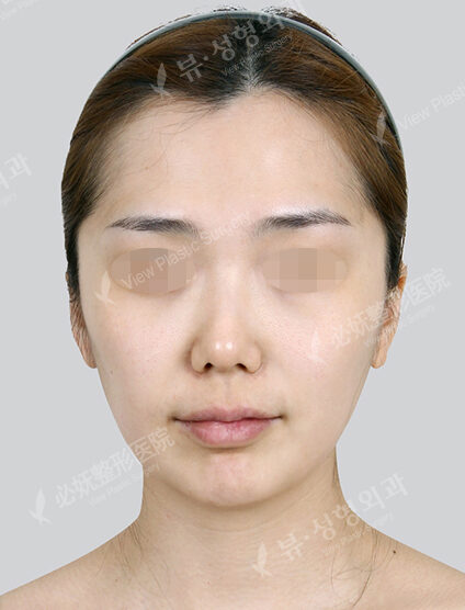 Doll Line (Vline)+ Zygoma Reduction+PA+Forehead , Cheeks Fat Graft+Rhinoplasty — Before