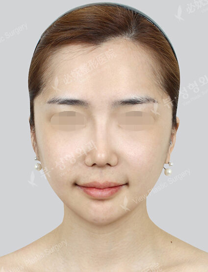 Doll Line (Vline)+ Zygoma Reduction+PA+Forehead , Cheeks Fat Graft+Rhinoplasty — After
