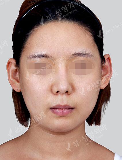 Natural Vline (Revisional Surgery)(1 Months) — Before
