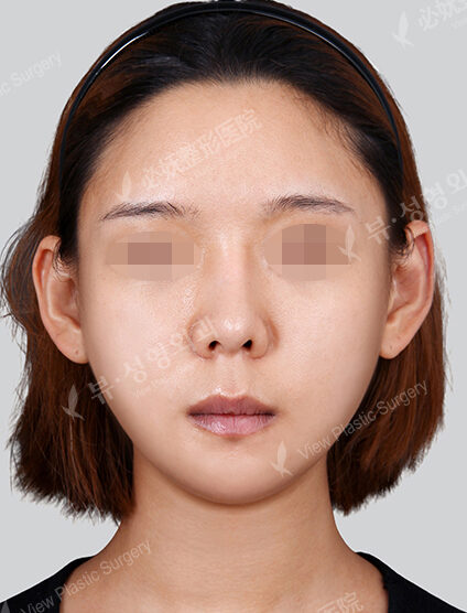 Natural Vline (Revisional Surgery)(1 Months) — After