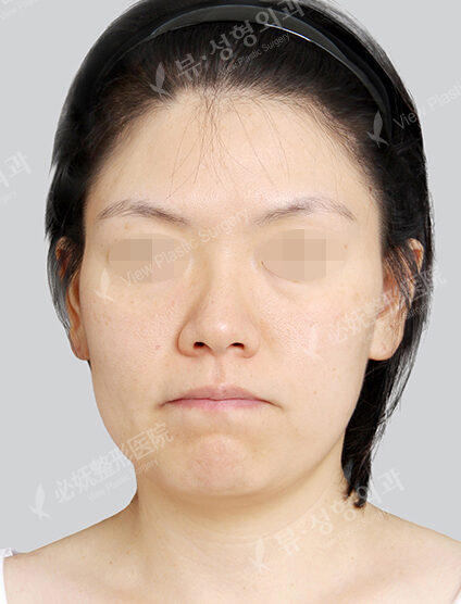 Natural Vline+Zygoma Reduction+Forehead Fat Graft (1 Months) — Before
