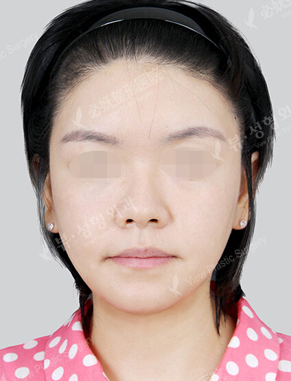 Natural Vline+Zygoma Reduction+Forehead Fat Graft (1 Months) — After