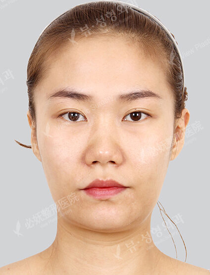 Natural Vline+Zygoma Reduction+Face Fat Graft (1 Months) — Before