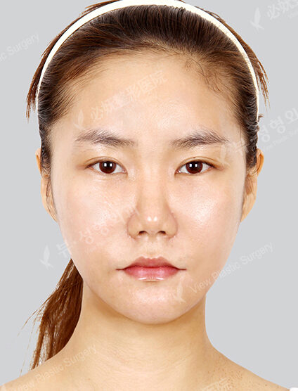Natural Vline+Zygoma Reduction+Face Fat Graft (1 Months) — After