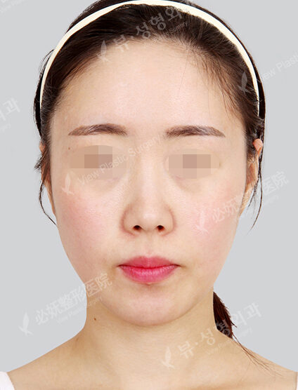 Forehead Reduction (1 Months) — Before