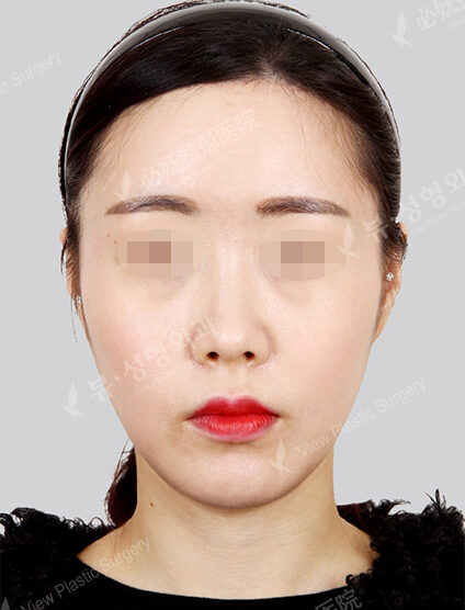 Forehead Reduction (1 Months) — After