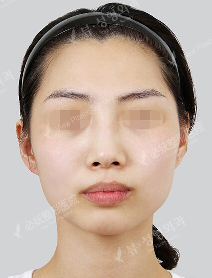 Doll Line (Vline)+ Zygoma Reduction+PA+Hump Nose(1 Months) — Before