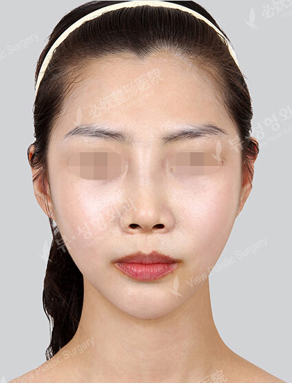 Doll Line (Vline)+ Zygoma Reduction+PA+Hump Nose(1 Months) — After