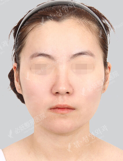 Natural Vline+Zygoma Reduction — Before