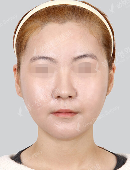 Natural Vline+Zygoma Reduction — After