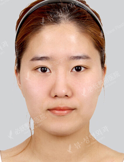 Natural Vline+Zygoma Reduction (4 Months) — Before